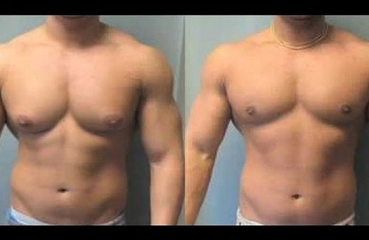 Erkeklerde meme büyümesi ' jinekomasti ' nasıl tedavi edilir?