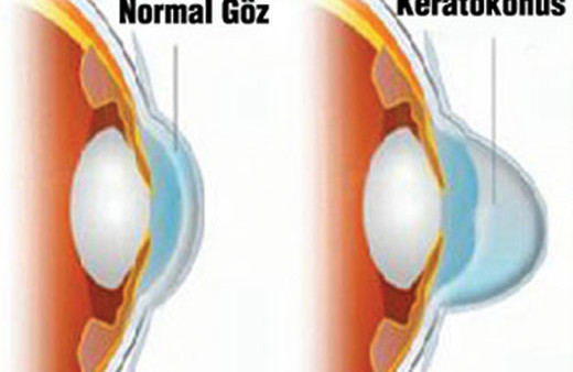 Keratokonus nedir?