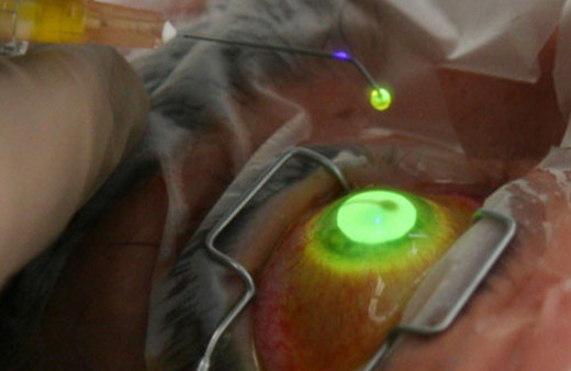 Keratokonus tedavisi nasıl yapılır?