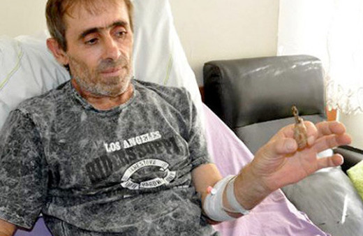 İdrar kesesinden bakın ne çıktı doktorlar inanamadı