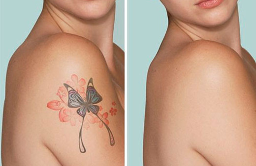 Renkli dövme silme işlemi nasıl yapılır?