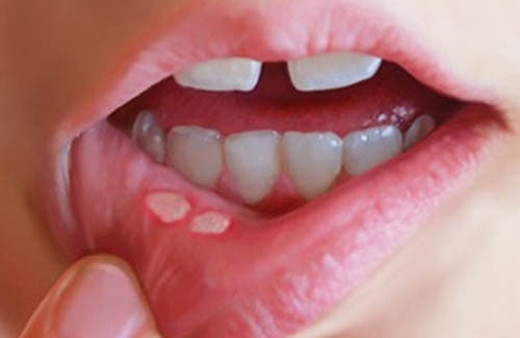 Ağzınızda bu yaralardan çıkıyorsa dikkat! Birçok hastalığa gebe