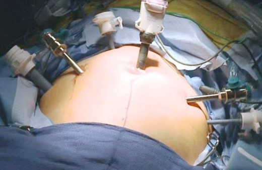 Mesane kanseri tedavisinde robotik cerrahi