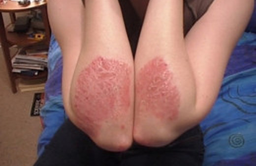 Sedef hastalığının belirtileri neler neden olur?