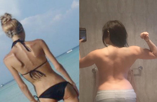 Anoreksiyadan kurtulan genç kızın mucizevi değişimi