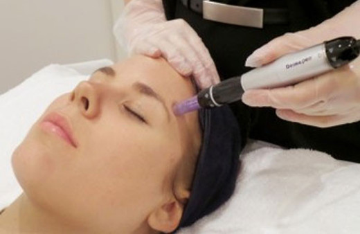 Dermapen uygulaması nedir?