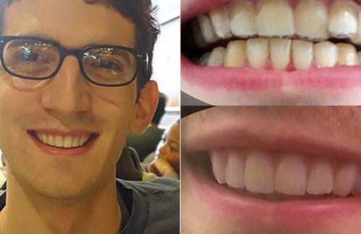 3D yazıcı ile dişlerini düzeltti