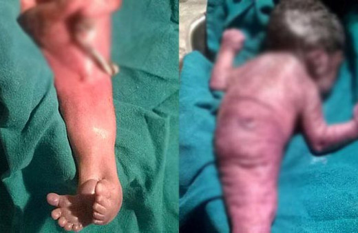 Deniz kızı bedeniyle doğdu! Dünya şokta