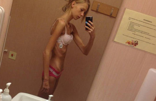 Yanlış diyet az daha öldürüyordu!