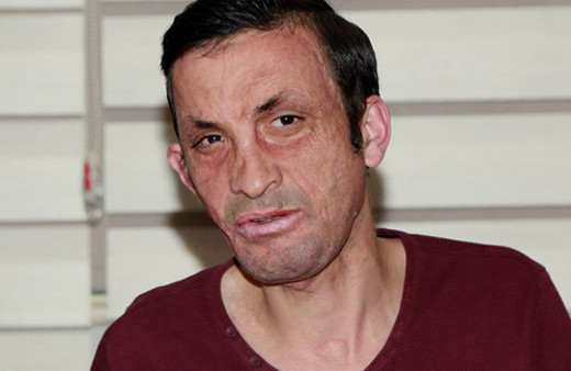 İlk yüz nakli yapılan Uğur Acar 5 yıl sonra böyle konuştu