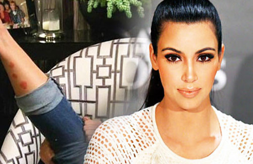 Kardashian'ın hastalığı yüzüne sıçradı !