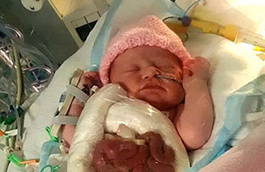 Bebeğin bağırsakları dışarıda doğdu