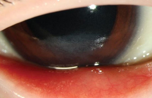 Sadece patates yeyince kör oluyordu