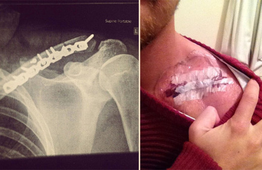 Vücudundan çıkarılan platinle öyle bir şey yaptı ki...