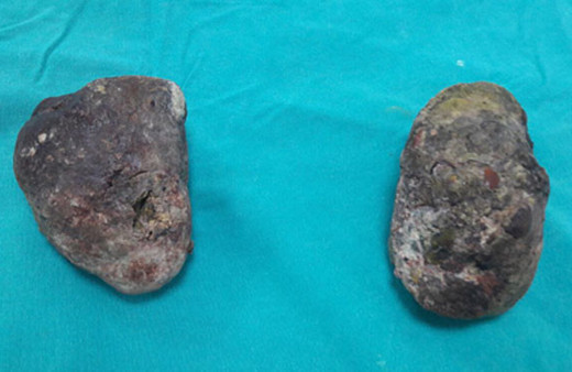 Yok artık! Trabzon hurması midede bu hale geldi!