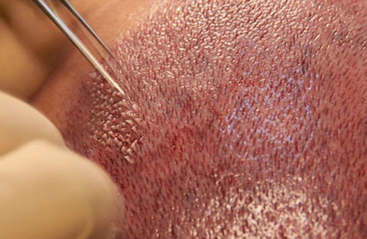 Saç ekimi hangi durumlarda yapılır?