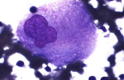 Nadir görülen hastalık "Gaucher" yaşamı tehdit ediyor