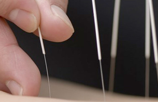  Devlet hastanesinde akupunktur tedavisi başladı 