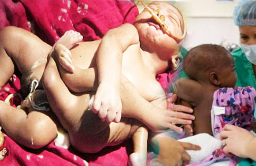 4 bacak ve 2 omurgayla dünyaya gelmişti! İnanılmaz bebek