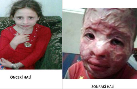 Suriyeli kız çocuğu böyleydi bu hale geldi