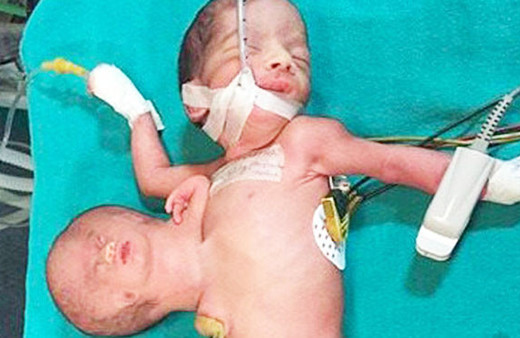 Yenidoğan bebeğin karnından çıkan doktorları şoke etti!