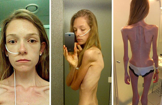 Aşırı zayıflıktan ölecekti şimdi bir içim su