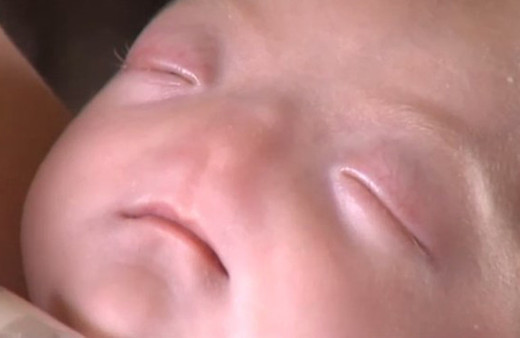 Burunsuz doğan bebek büyüdü