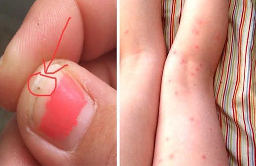 Kızının tırnağında siyah bir nokta fark etti hemen hastaneye koştu