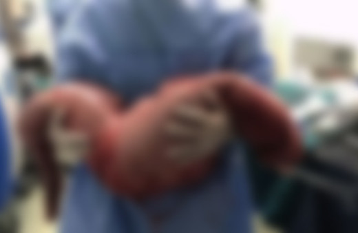 Bağırsaklarından 13 kilo dışkı çıktı