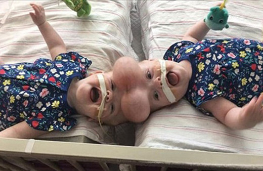 Yapışık ikizlerin ameliyatla ayrıldı 