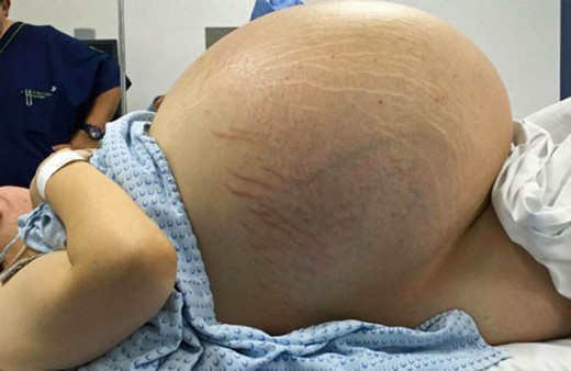 Karnı her geçen gün büyüdü herkes hamile sandı ama gerçek başka!