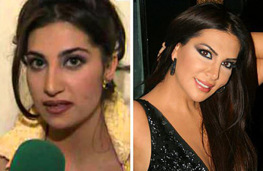 Estetikle müthiş değişen Türk ünlüler