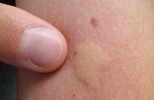 Sivrisinek ısırığına karşı ne yapılır?