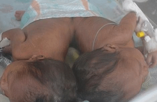 İkizlerin hayatı için büyük mucize tam 50 doktor...