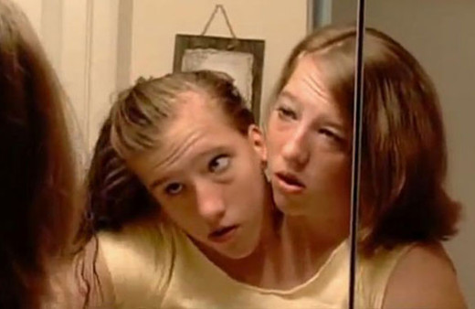 Bir vücutta iki hayat! Yapışık ikizleri dünya konuşuyor