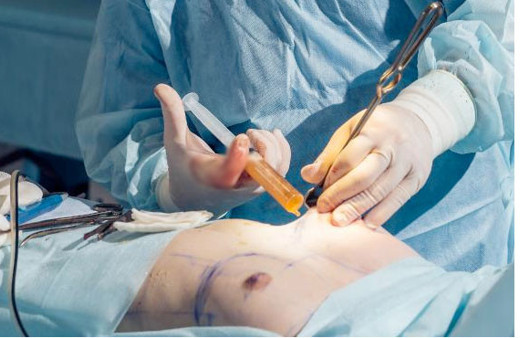 Erkekler en çok meme küçültme operasyonuna başvuruyor