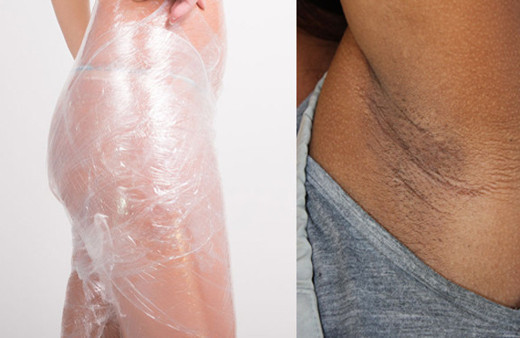 Koltuk altı kararmasından selülite kadar kesin çözüm!