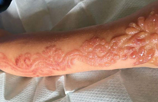 Küçük kızın kolu bu hale geldi hayatı zehir oldu bakın neden