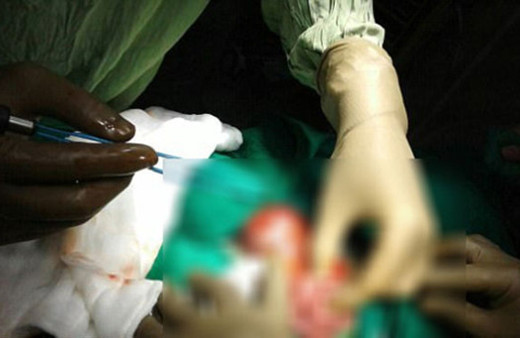 İkizi karnından çıktı