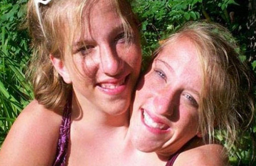 Onlar tek beden de iki ayrı dünya yapışık ikizler dünyayı şaşırttı