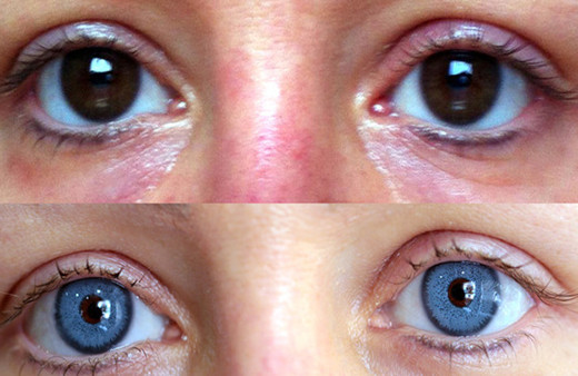 Göz rengi değiştirme ameliyatı az daha kör ediyordu