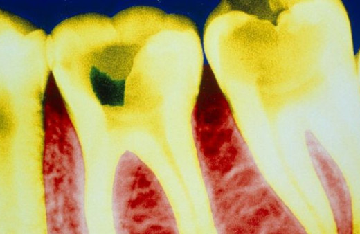 Aspirin'in inanılmaz bir faydası çıktı çürüyen dişleri...