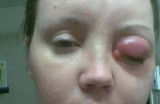 Lensinden bulaşan mikrop hayatını kararttı