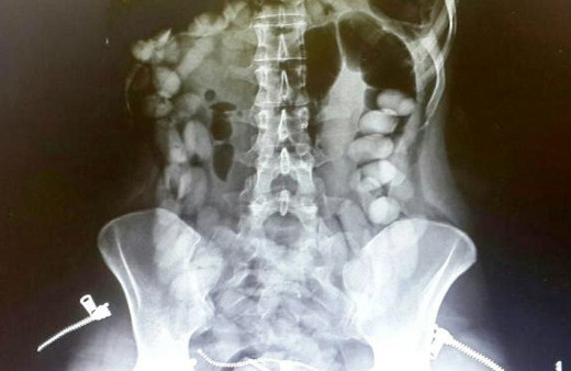 Antalya havaalanında yakalandı midesinden çıkana bakın