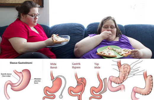 Tüp mide gastrik bypass ve kelepçe ameliyatı nedir hangisi iyi?