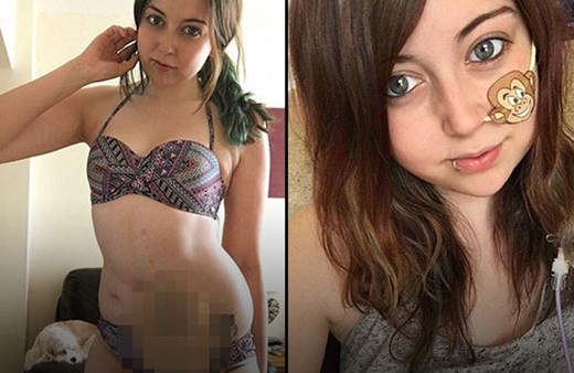 17 yaşında bağırsaklarını aldırdı: Yeni hayatına böyle başladı!