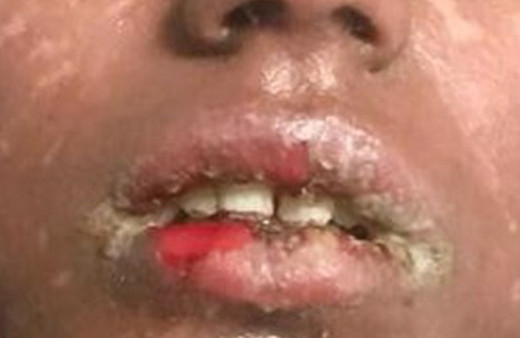 Stevens Johnson Sendromu nedir? Bu belirtileri varsa...