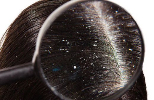 Muz ve avokadoyu karıştırıp kafanıza sürün... İşte kepekten kurtulmanın 5 doğal yolu!