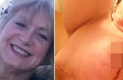 Göğüslerini küçültmek için bıçak altına yattı üçüncü memesi çıktı! 