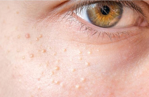 Yüzdeki küçük beyaz noktalar neden oluşur?